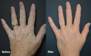 beforeandafter-pigmentation-hands