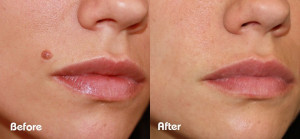 beforeandafter-skin-tag-lip