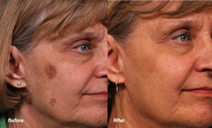 beforeandafter-pigmentation-cheek2