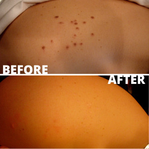 beforeandafter-cherry-angiomas