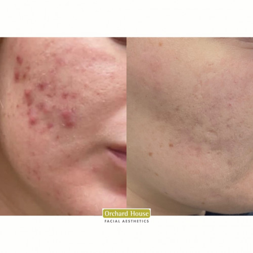 Acne before and after Orchard House Results
