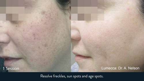 lumecca-freckles-sunspots-age-spots