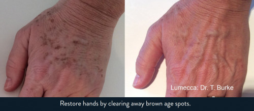lumecca-hands-brown-age-spots