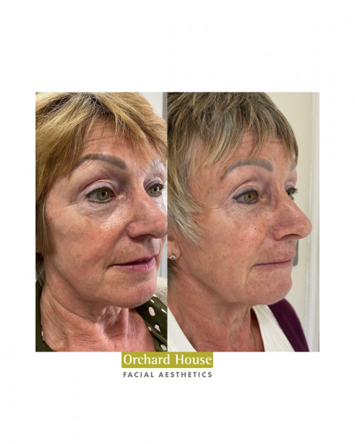 Before after Structura