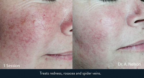 lumecca-redness-rosacea-spider-veins