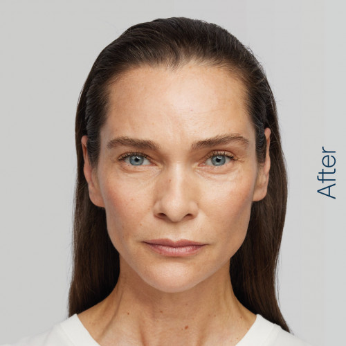 image of model after radiesse treatment,  available at Orchard House Northallerton