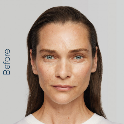 image of model before radiesse treatment,  available at Orchard House Northallerton