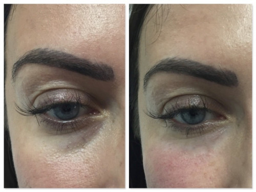 tear troughs before and after
