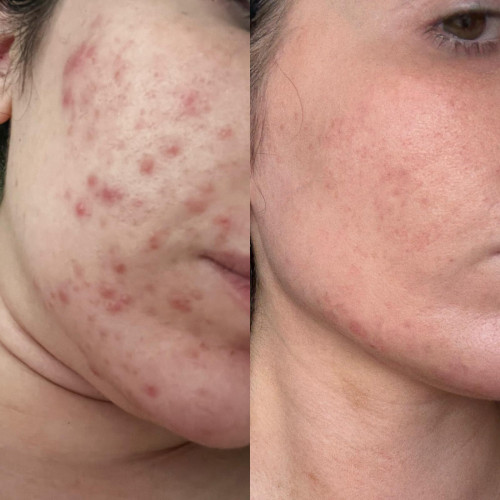 Acne before and after Orchard House Results with BIOJUVE