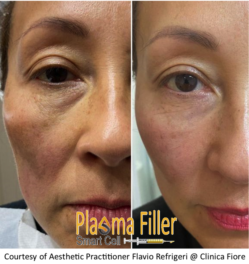 Results Plasma Filler female