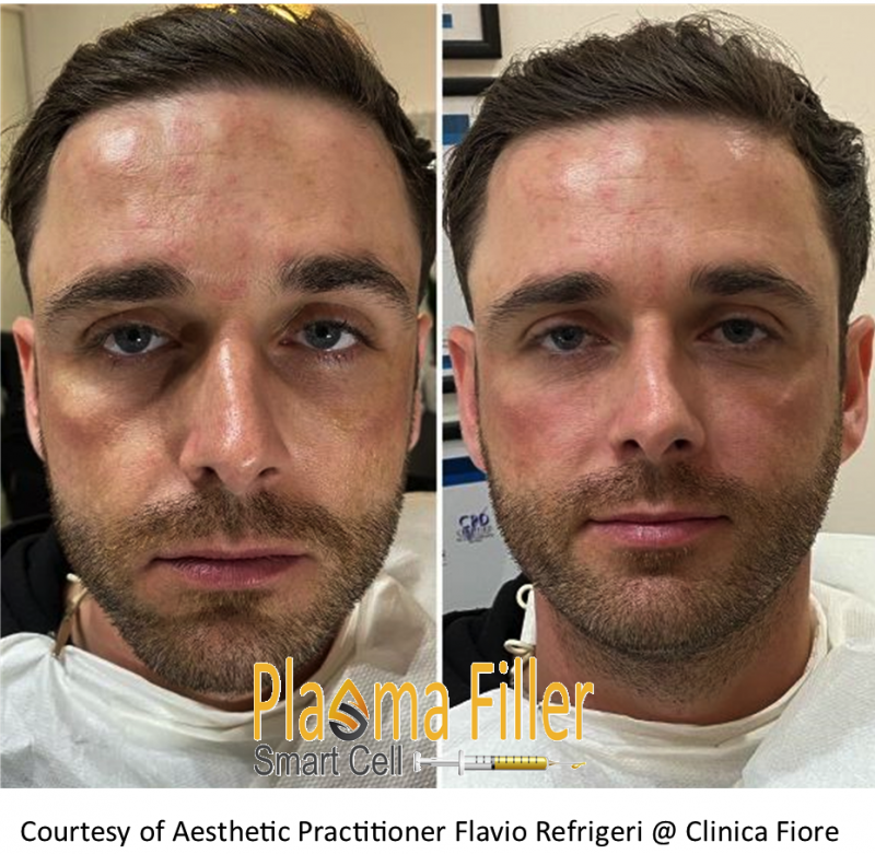 Results Plasma Filler Male