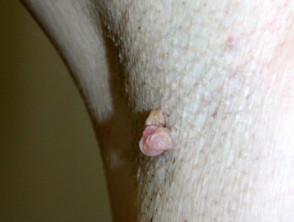 skin tag image