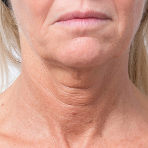 Neck before Profhilo