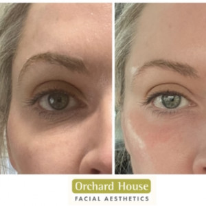 image of Dr Stephanie Plasma filler eyes and temples before and after