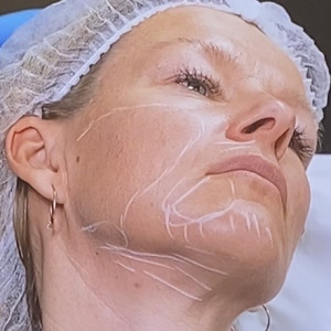 Model lower face Radiesse treatment Northallerton