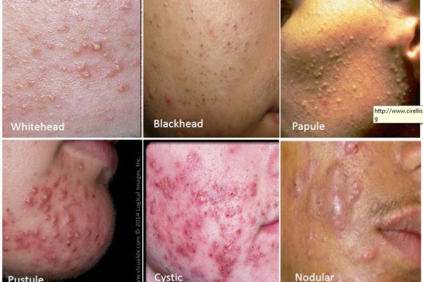 acne-types