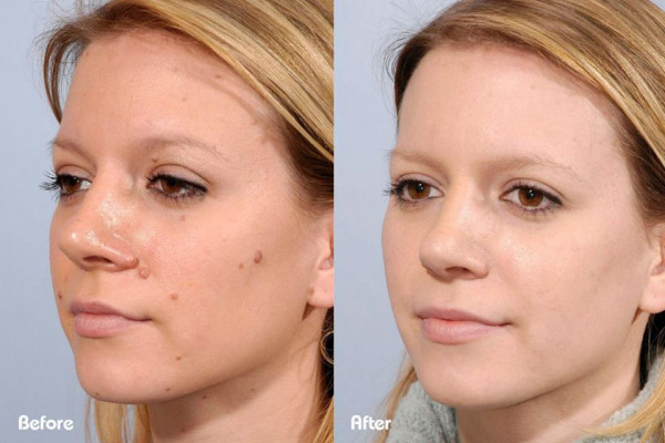 beforeandafter-moles