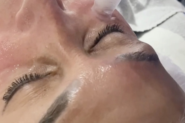 xcellaris twist microneedling eyes