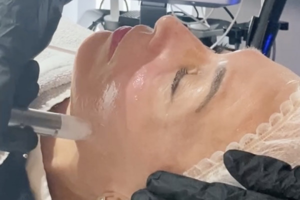 xcellaris twist microneedling