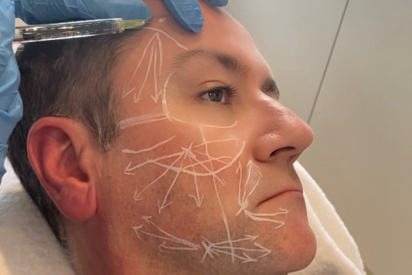 David marked up for LanLuma treatment
