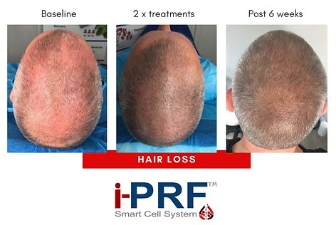 iPRF Hair Restoration