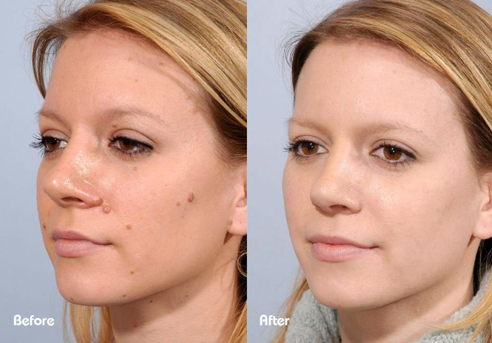 beforeandafter-moles