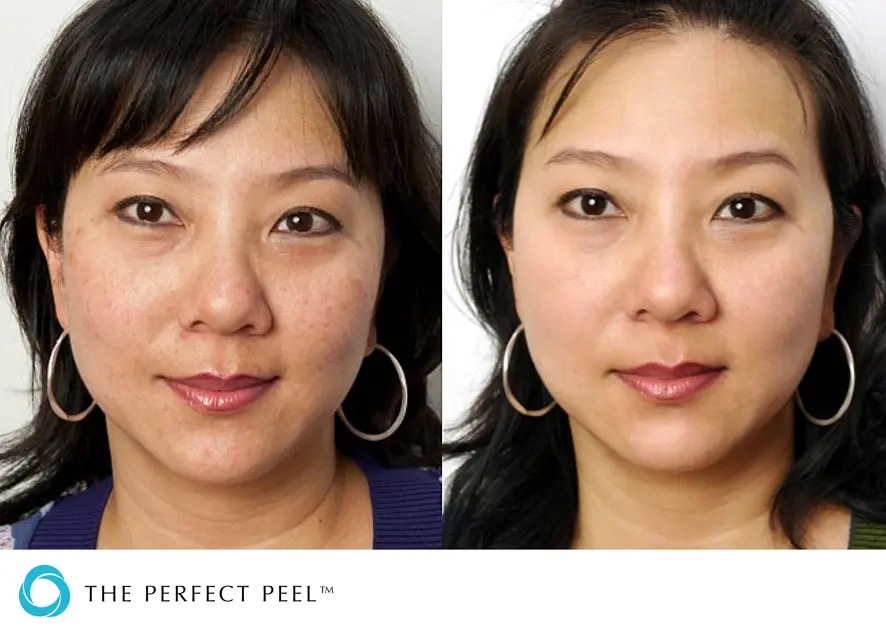 Perfect Peel before after 2