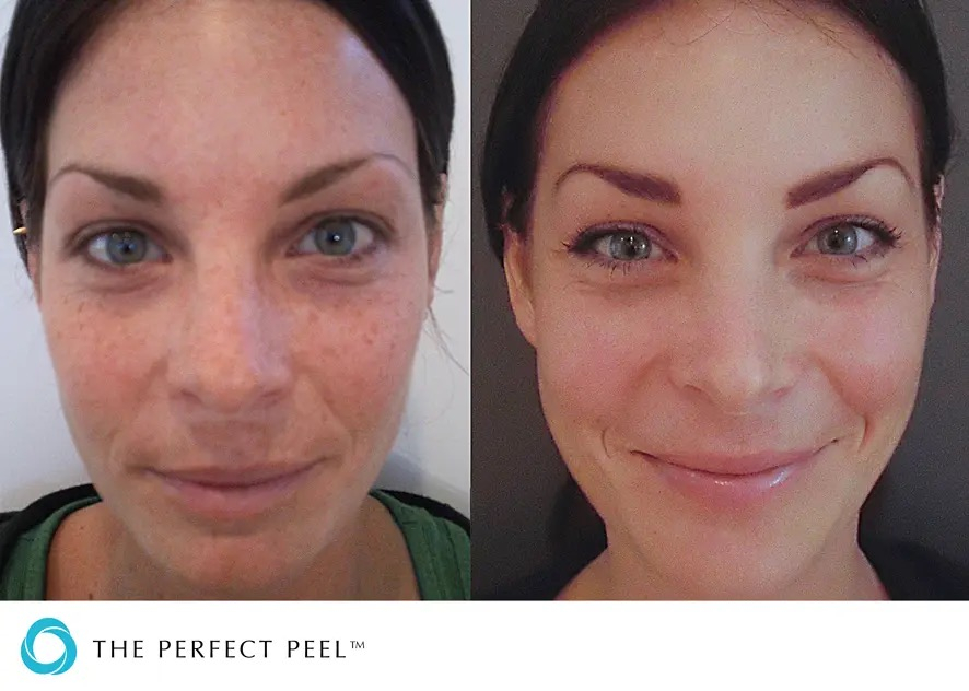 Perfect Peel before after 1